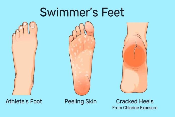 Symptoms of Swimmers Feet including athlete’s foot, cracked heels, and fungal infection