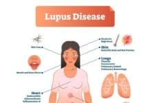 Acne vs Lupus: Differential Diagnosis & Symptoms Guide A close-up image showing the red, fixed butterfly rash (malar rash) across the cheeks and bridge of the nose, characteristic of Systemic Lupus Erythematosus (SLE). differrentiating acne vs lupus
